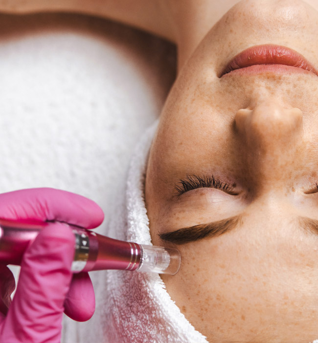 Microneedling